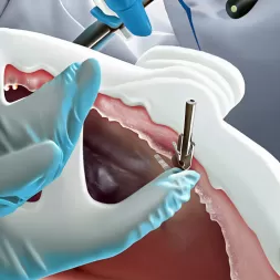 How to Properly Place a Dental Dam for Cavity Treatment
